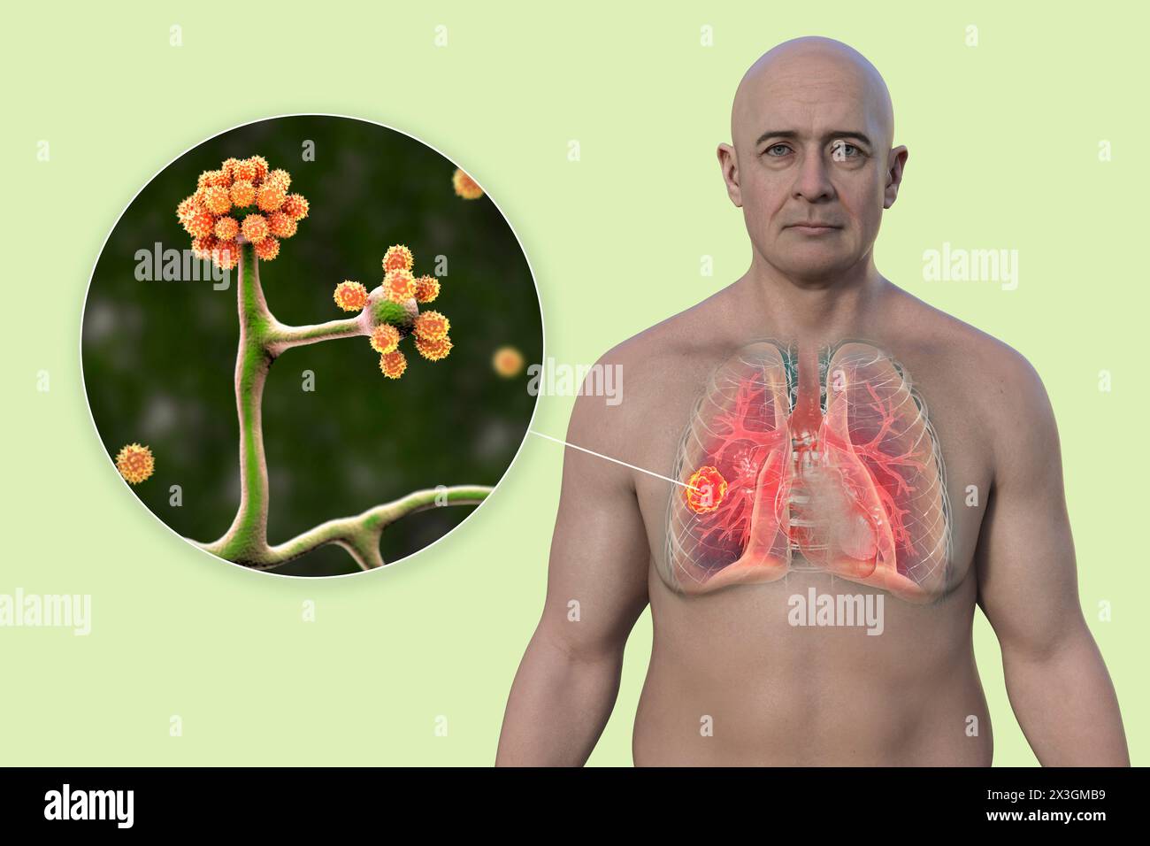 Illustration of a man with a lung mucormycosis lesion and a close-up view of Cunninghamella bertholletiae fungi, one of the etiological agents of lung mucormycosis. Stock Photo