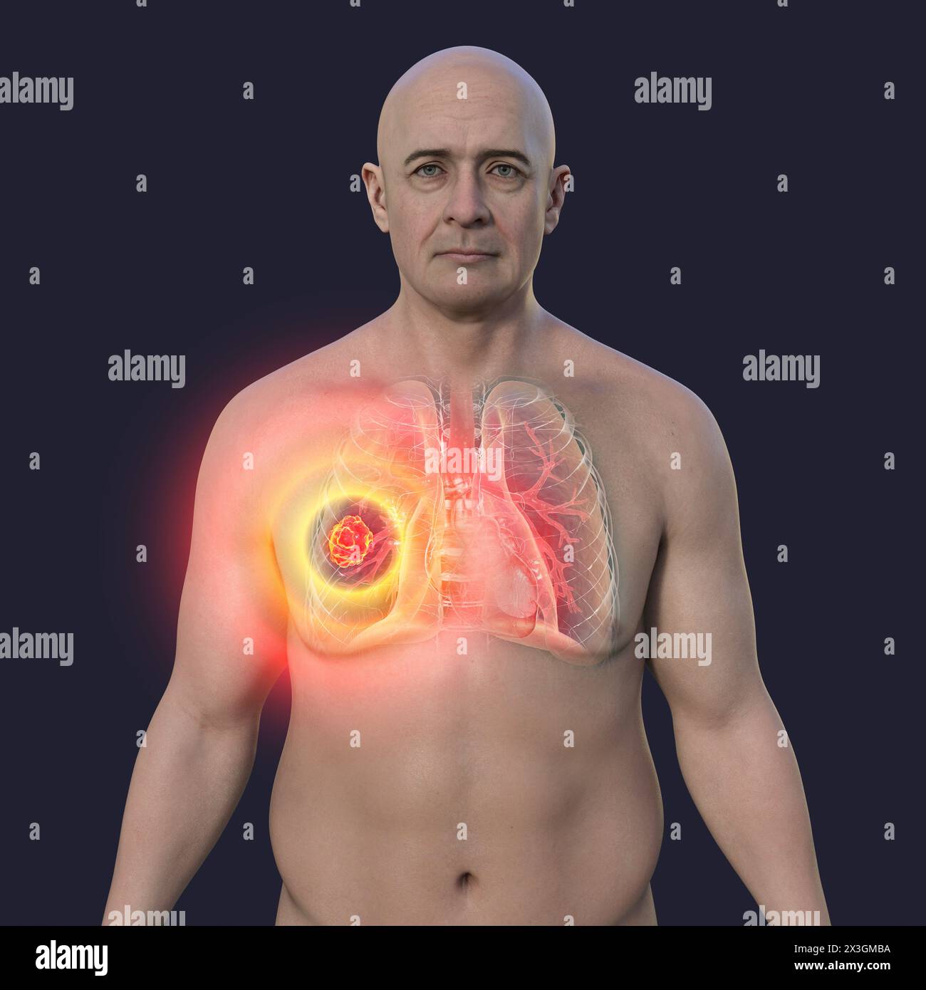 Illustration of a man with a lung mucormycosis lesion. Stock Photo