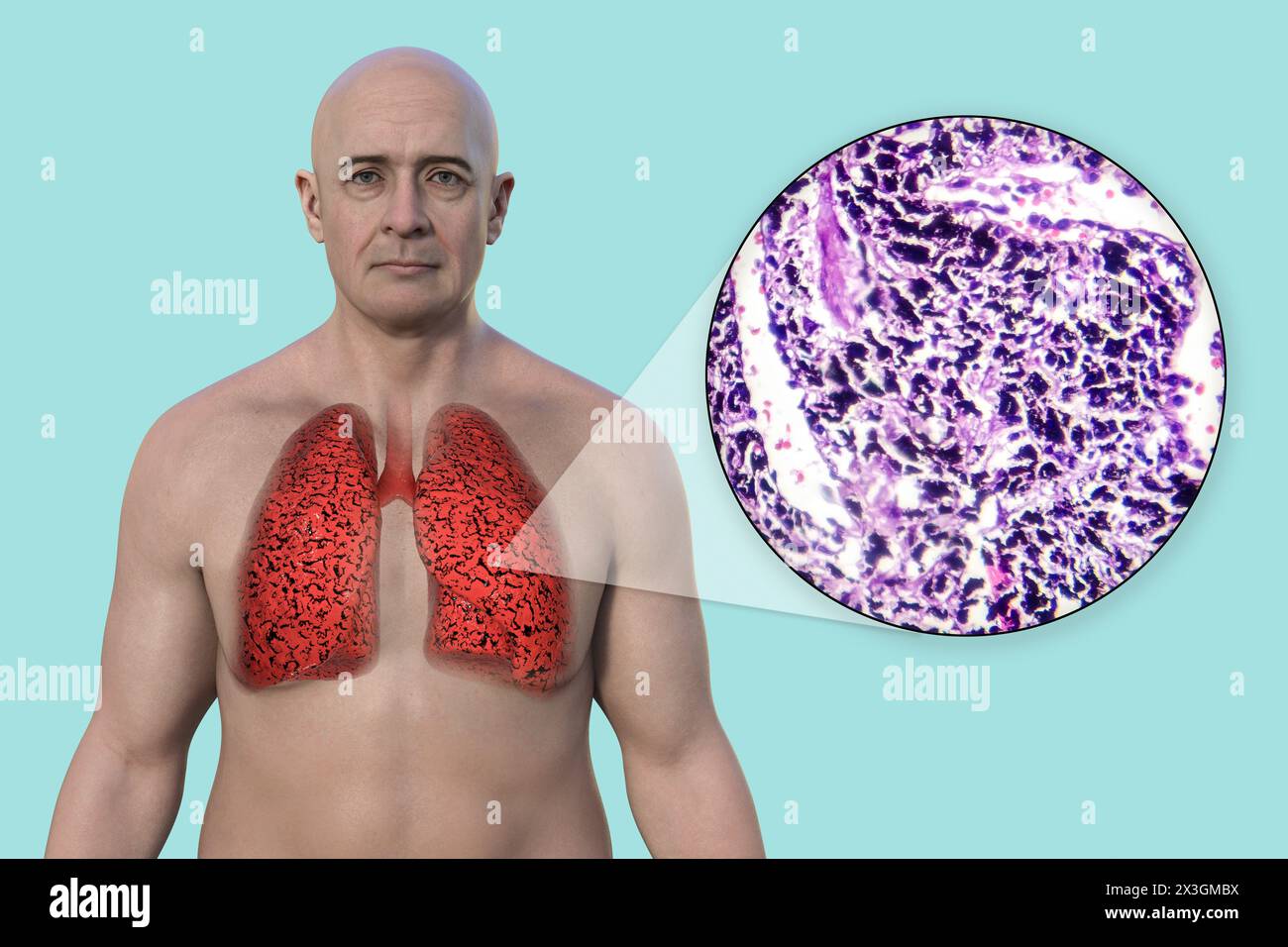 Illustration of a man with smoker's lungs, along with a micrograph image of lungs affected by smoking. Stock Photo