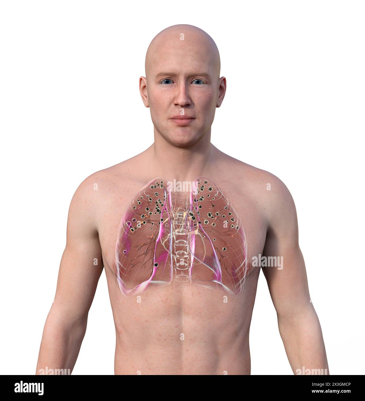 Illustration of a man with silicosis nodules in the lungs, emphasising the impact of silica exposure. Stock Photo