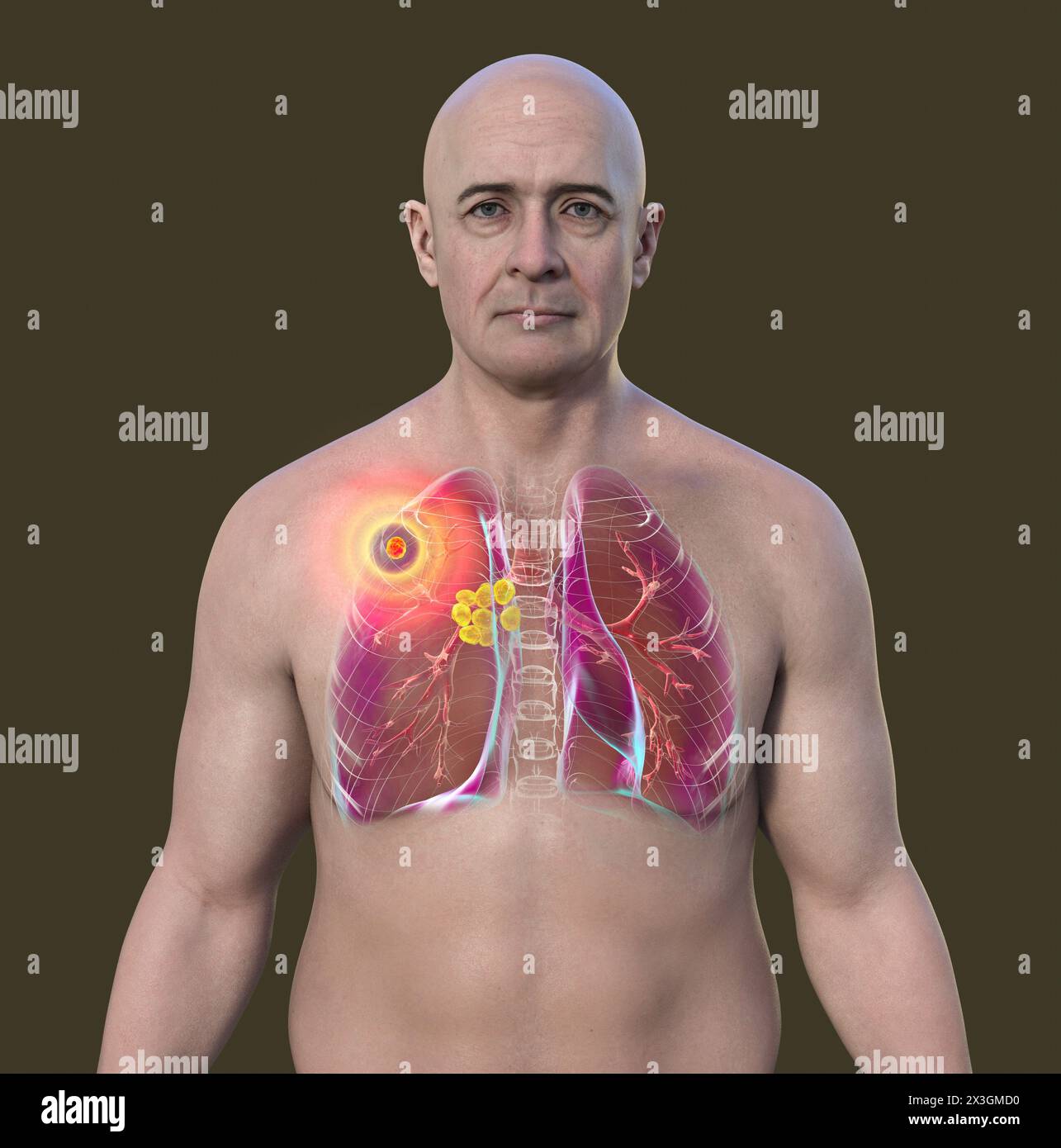 Illustration of a man with primary lung tuberculosis, revealing the