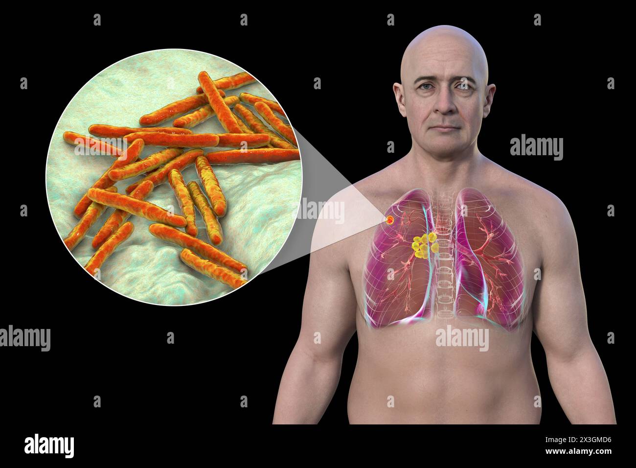 Illustration of a man with primary lung tuberculosis, revealing the Ghon complex and mediastinal lymphadenitis and a close-up view of Mycobacterium tuberculosis bacteria. Stock Photo