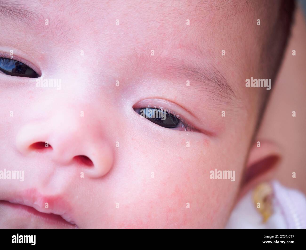 newborn baby with dermatitis allergy on face Stock Photo