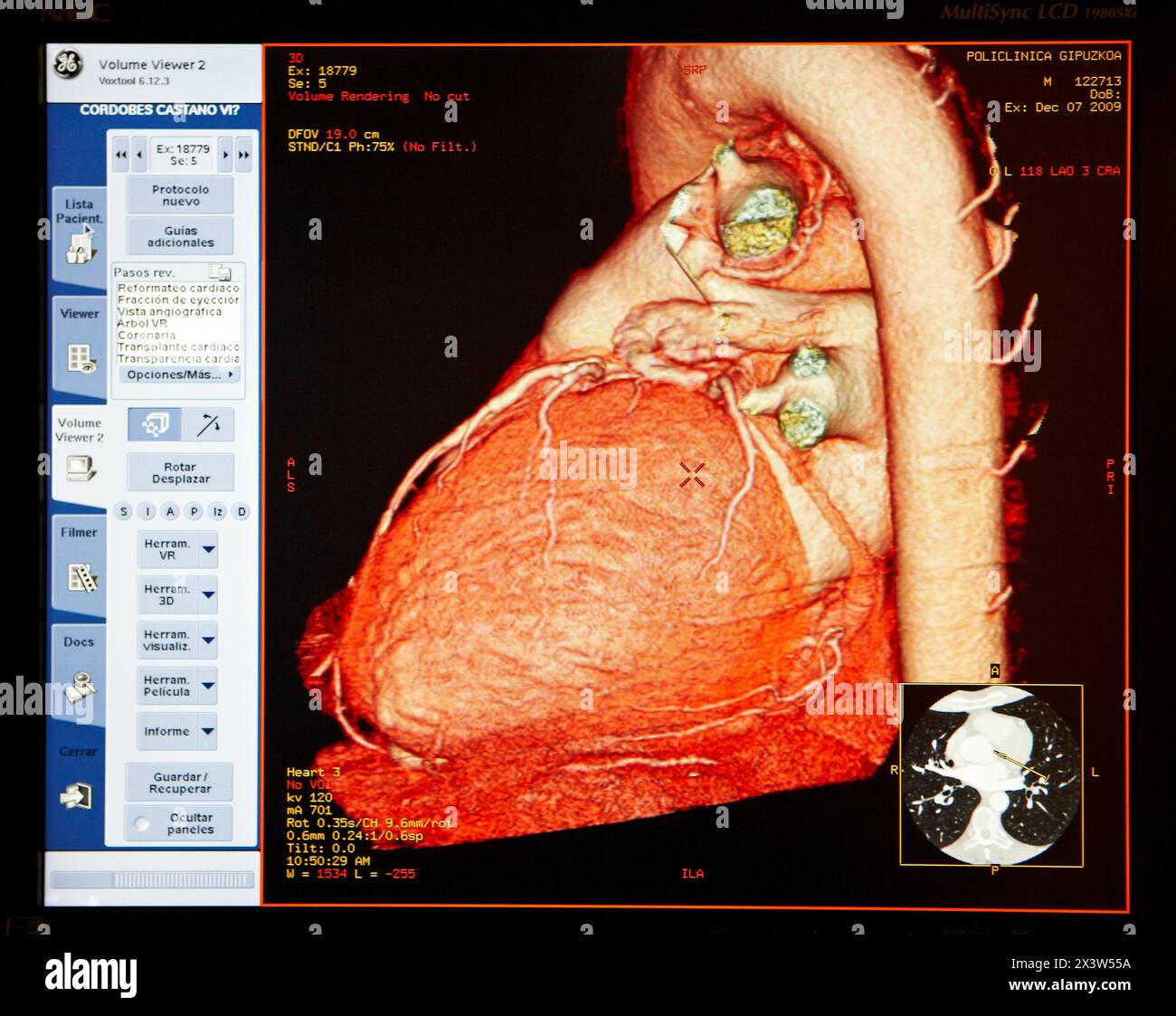 Heart, arch of the aorta and coronary arteries, CAT (Computerized Axial ...