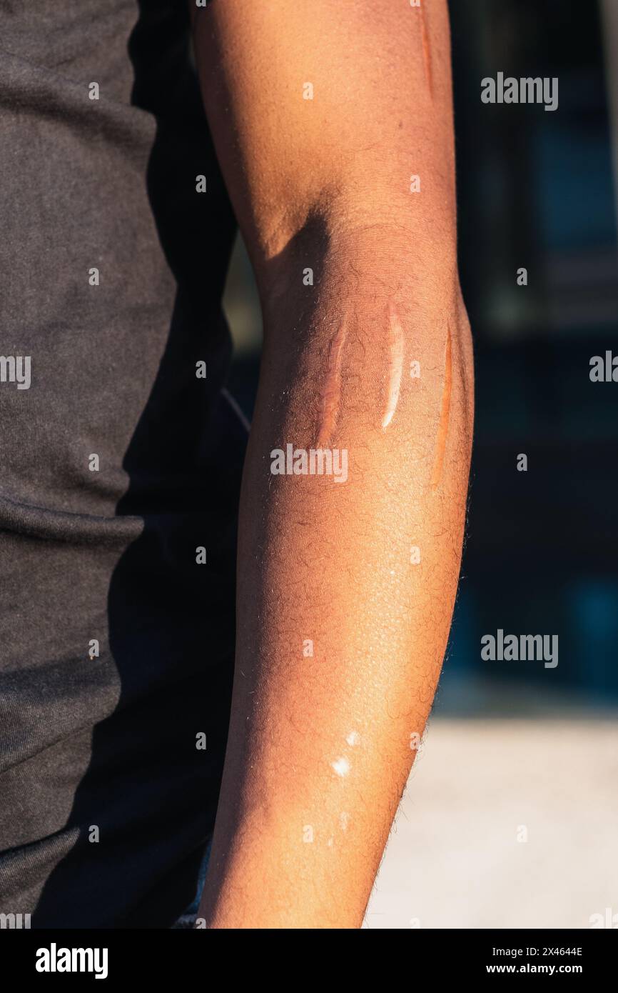 Scared Arm Scars arm hi-res stock photography and images - Alamy