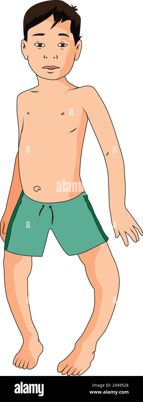 Boy suffering from blount's disease Stock Vector Image & Art - Alamy