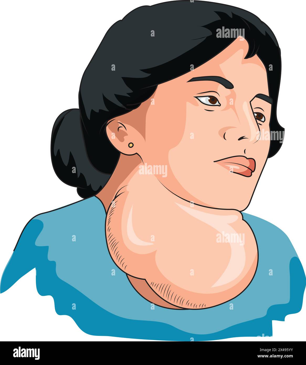 Woman suffering from goitre Stock Vector