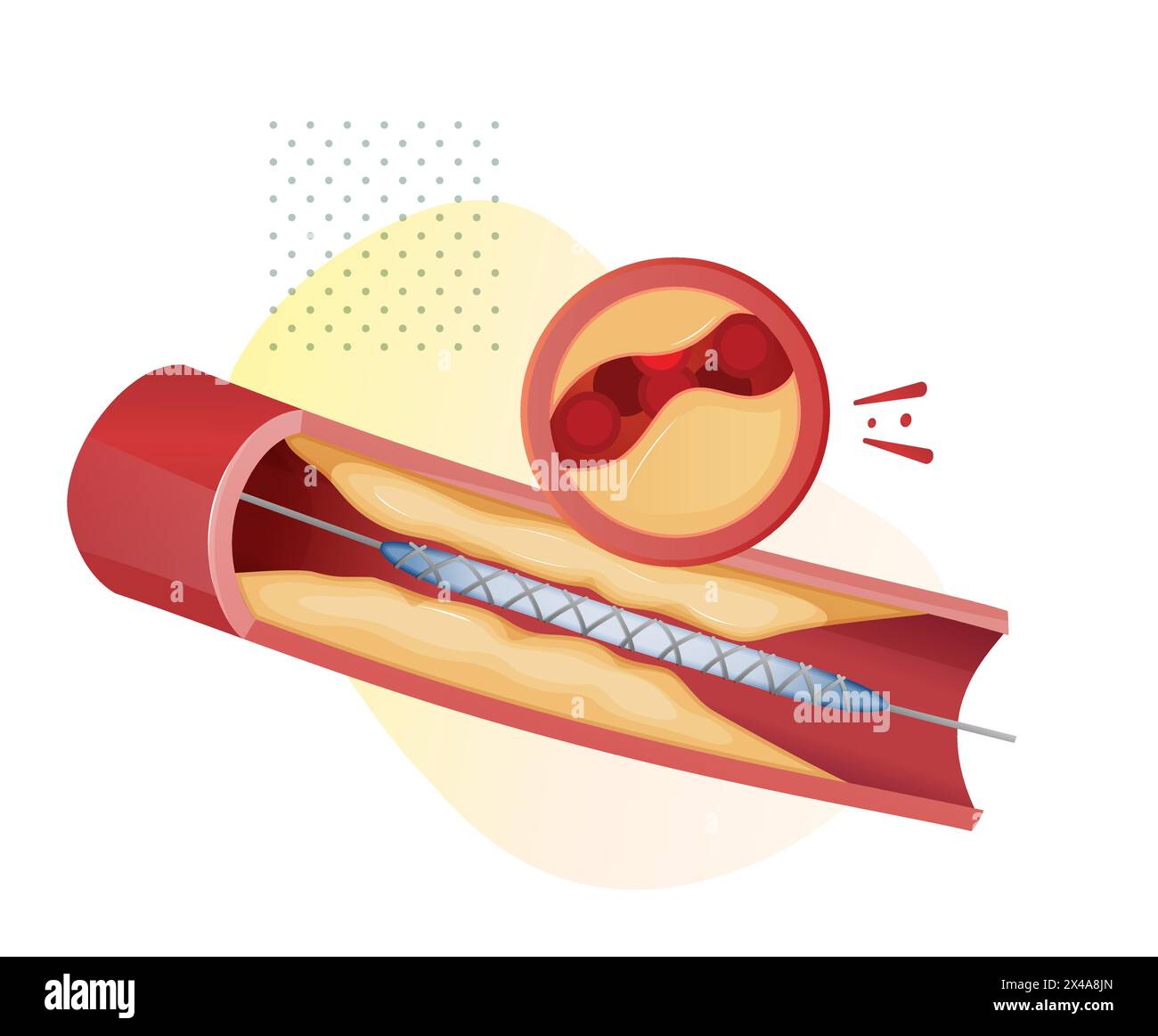 Atherosclerosis Stages - Cholesterol Plaque Buildup - Stock ...