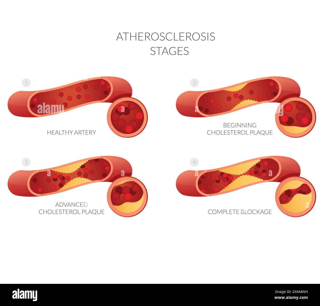 Atherosclerosis Stages Cholesterol Plaque Buildup Stock