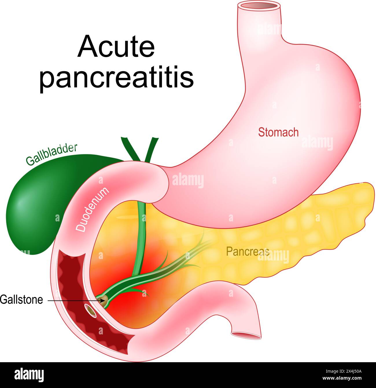 Acute pancreatitis. Pancreas inflammation. Realistic image of abdominal organs Gallbladder, Duodenum, Stomach, and Pancreas. Close-up of a Gallstone t Stock Vector