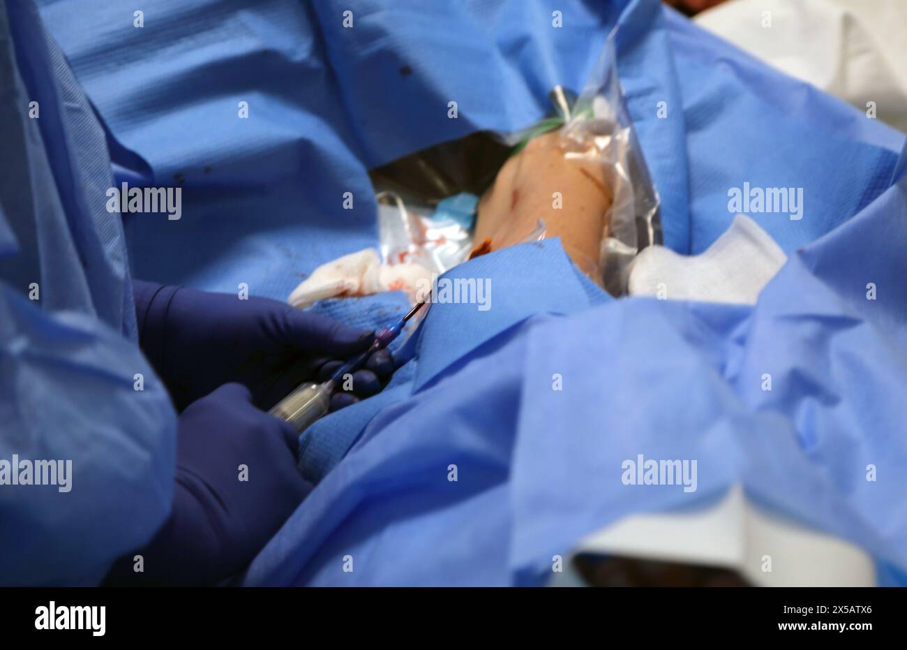 Patient having Peripherally Inserted Central Catheter (Picc Line