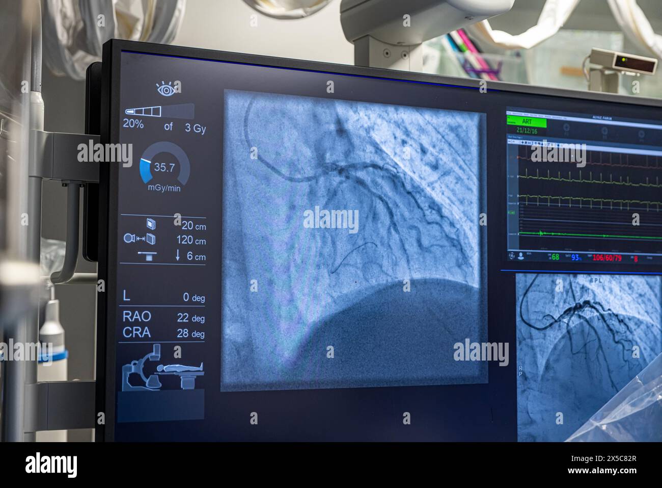 Denizli Turkey-28 February 2024; Doctors conduct a diagnostic operation.Coronarography.Percutaneous coronary intervention-recanalization, balloon angi Stock Photo