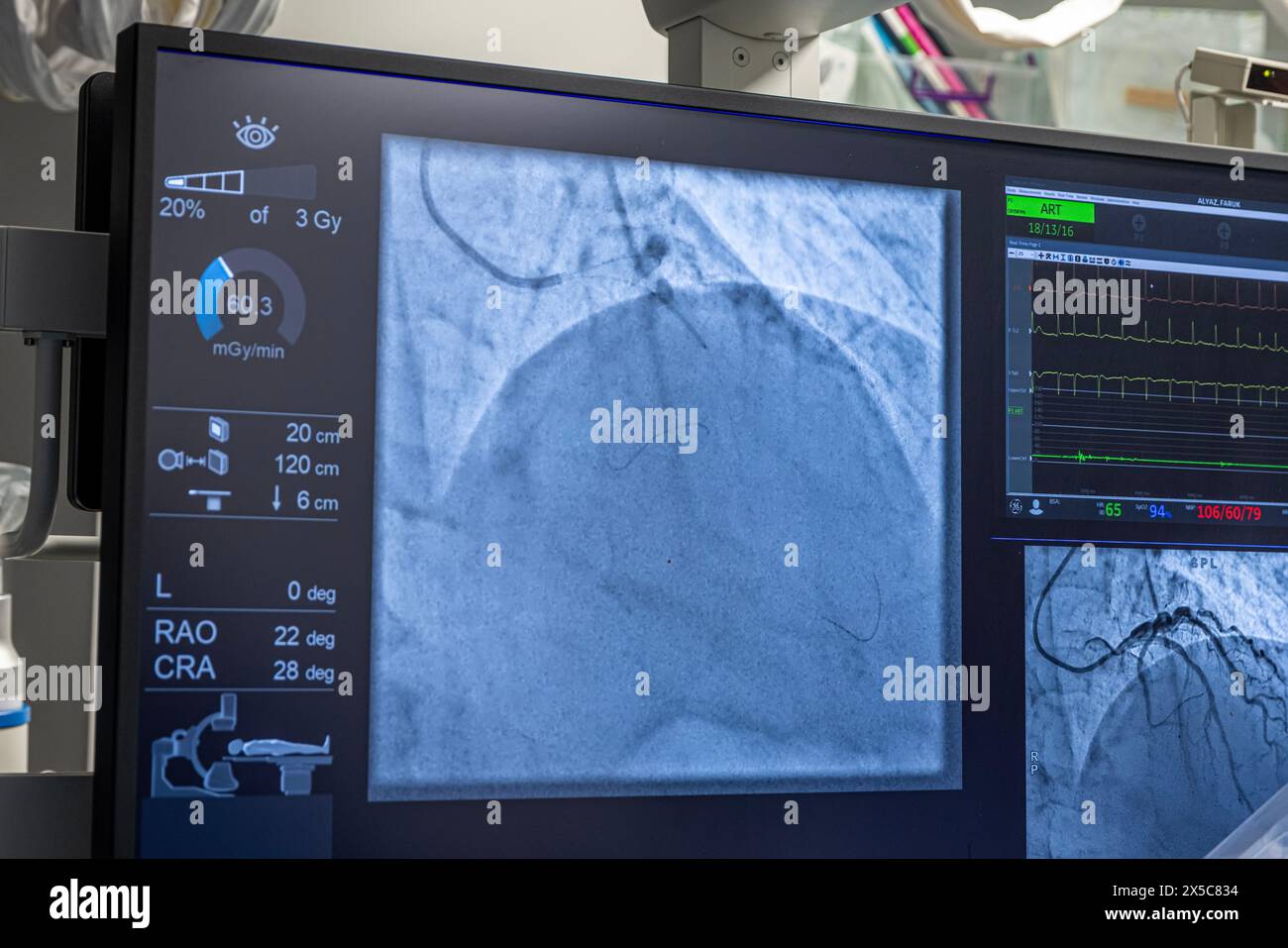 Denizli Turkey-28 February 2024; Doctors conduct a diagnostic operation.Coronarography.Percutaneous coronary intervention-recanalization, balloon angi Stock Photo