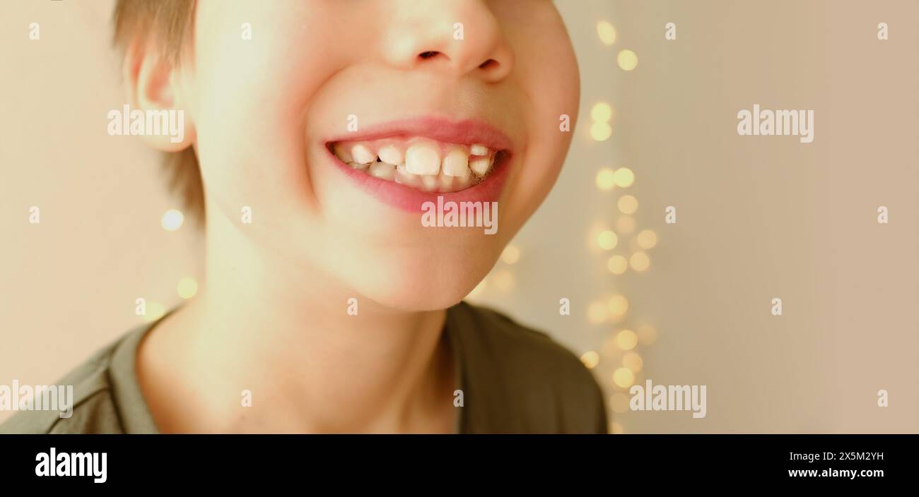 closeup crooked teeth, boy 9-10 years opened mouth, child 8 years old shows teeth, visit to dentist for examination oral cavity, control of molars, te Stock Photo