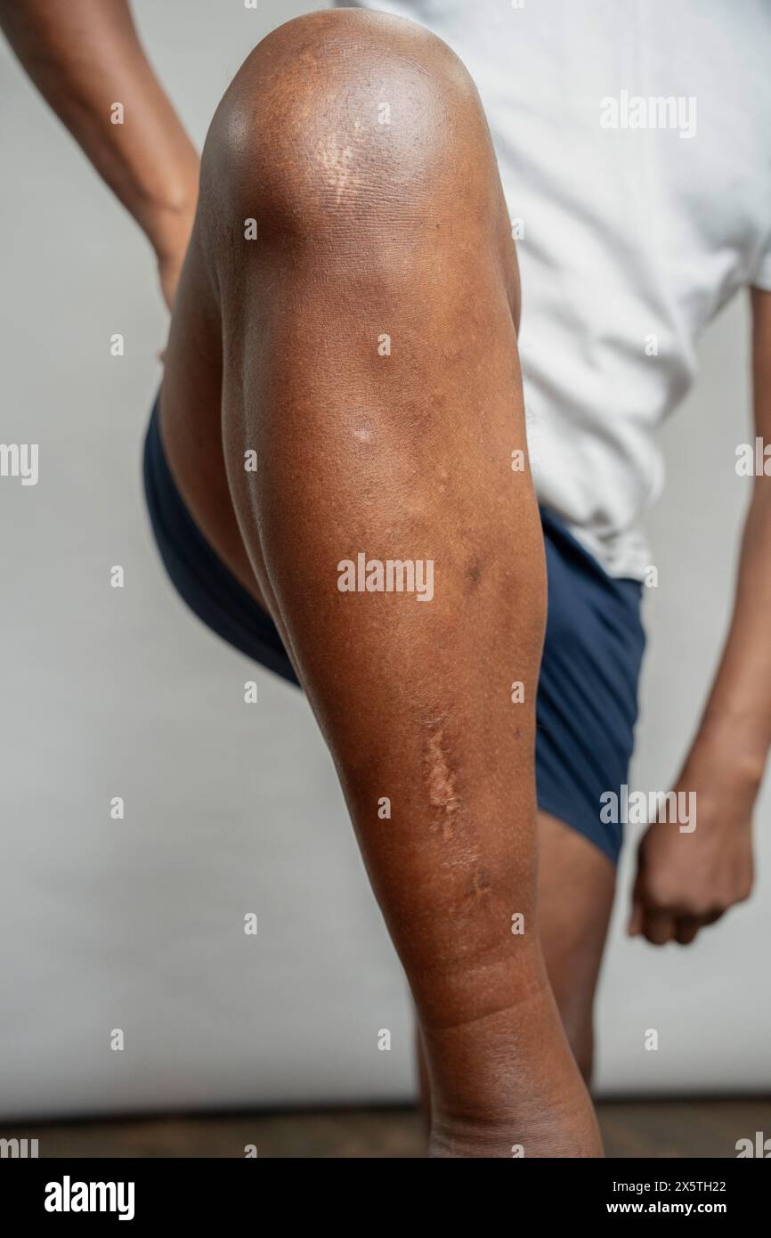 Man showing leg with scars against gray background Stock Photo