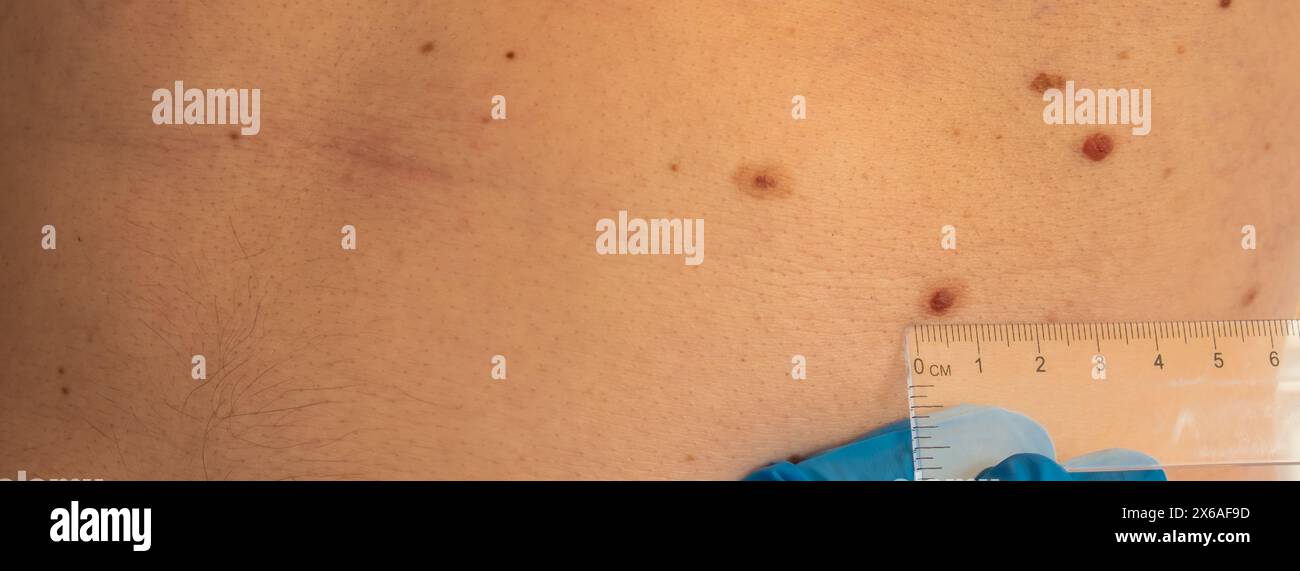 Ruler Rash Size Skin test ruler hi-res stock photography and images - Alamy