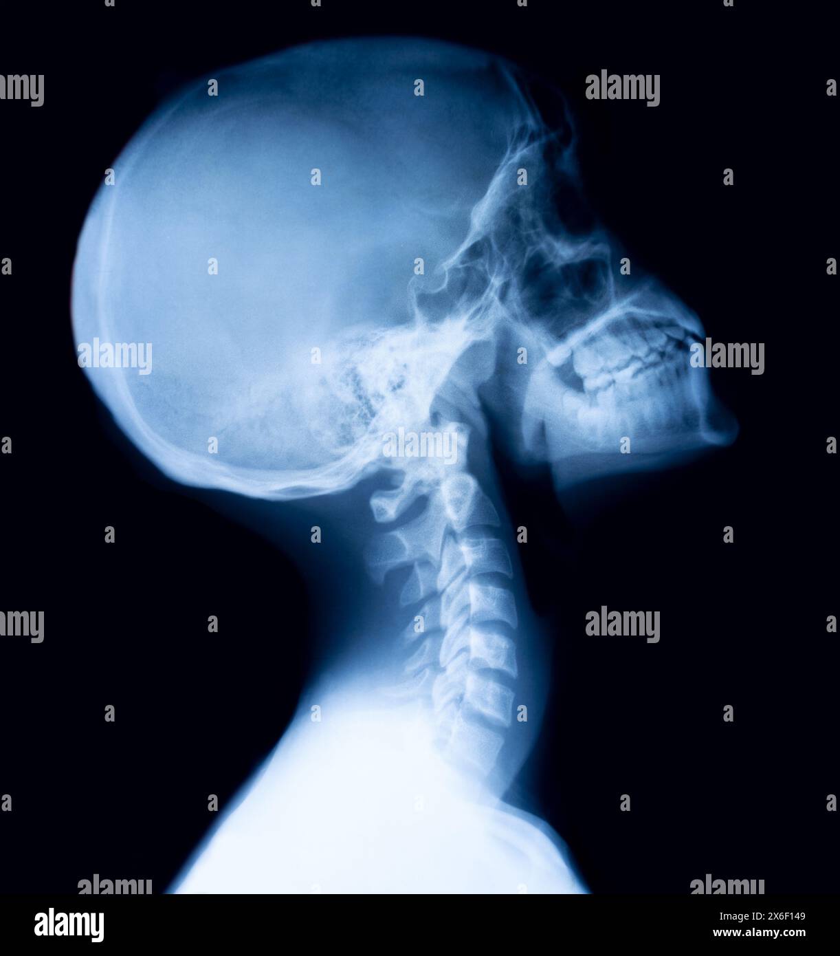 Side view cervical spine skull hi-res stock photography and