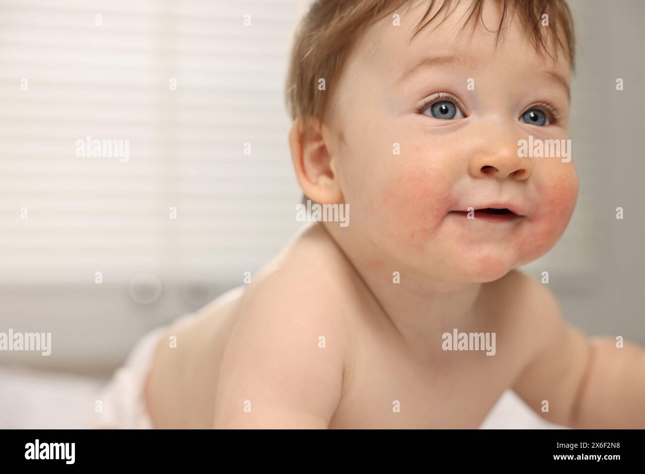 Cute little baby with allergic redness on cheeks indoors Stock Photo