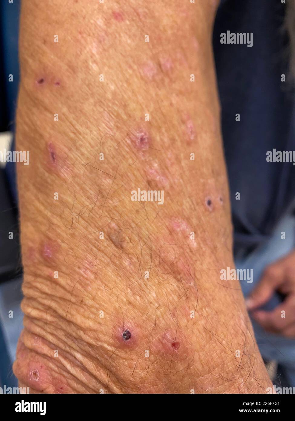 scratches-on-the-skin-of-a-62-year-old-hispanic-male-patient-with