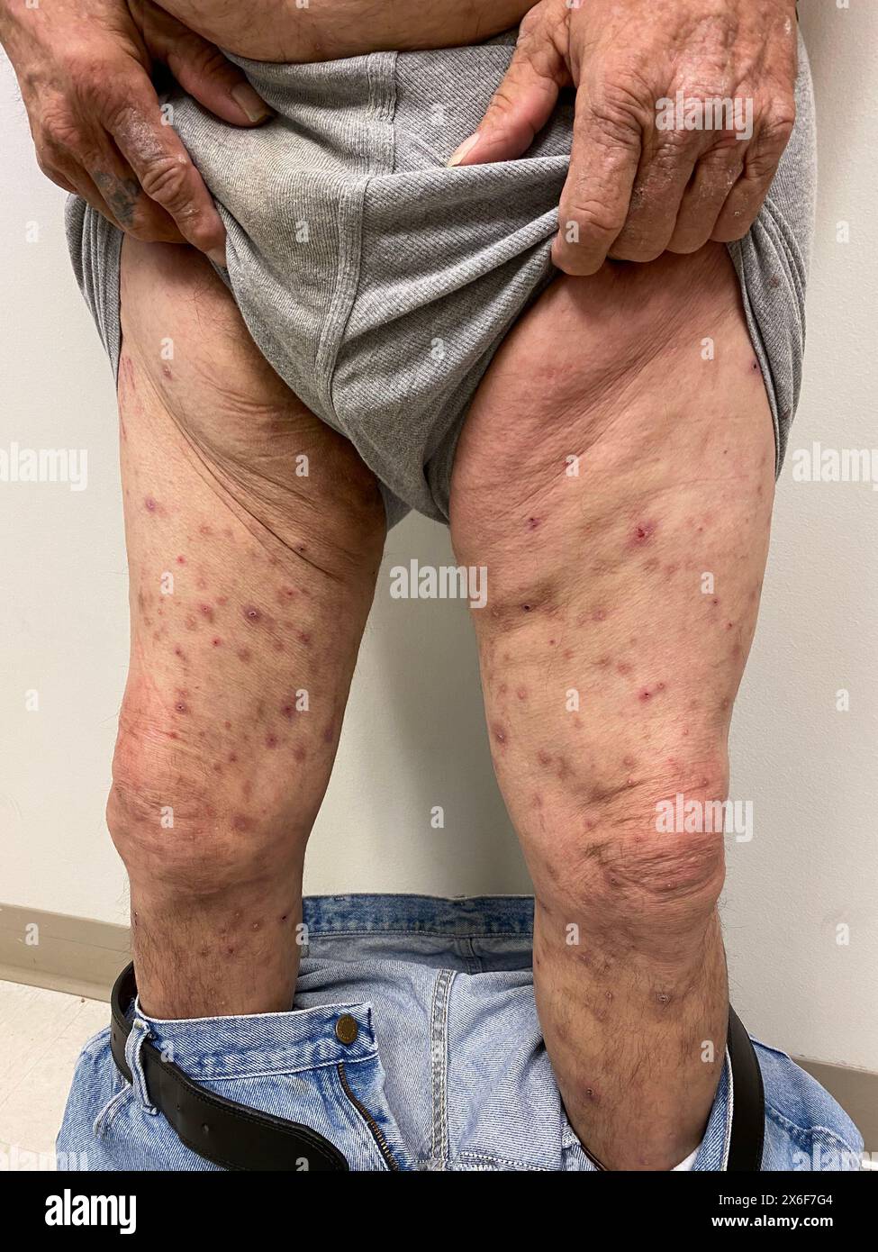 scratches-on-the-skin-of-a-62-year-old-hispanic-male-patient-with