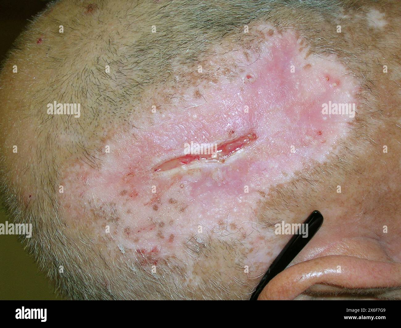 gabapentin stop itching