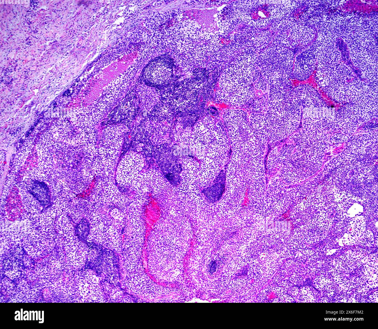 Light Micrograph Showing A Human Lymph Node Almost Completely Invaded Light Micrograph Showing A Human Lymph Node Almost Completely Invaded