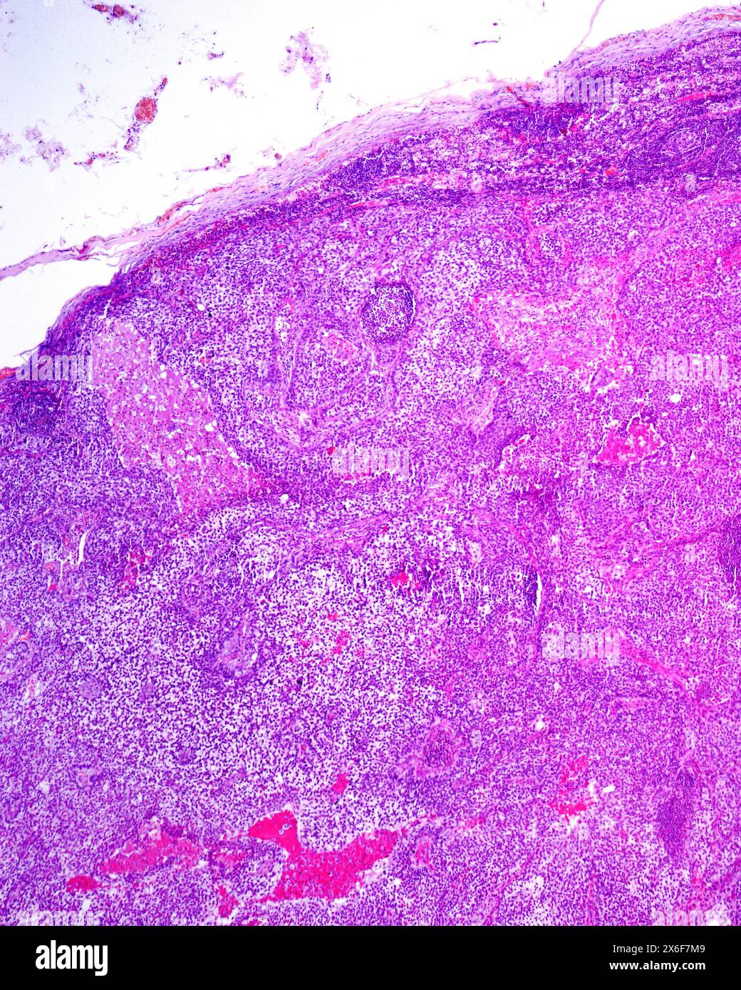 Light Micrograph Showing A Human Lymph Node Almost Completely Invaded Light Micrograph Showing A Human Lymph Node Almost Completely Invaded