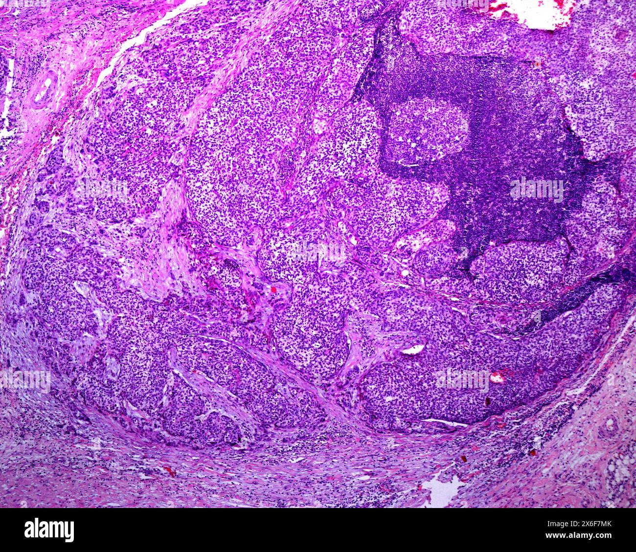 Light Micrograph Showing A Human Lymph Node Almost Completely Invaded Light Micrograph Showing A Human Lymph Node Almost Completely Invaded