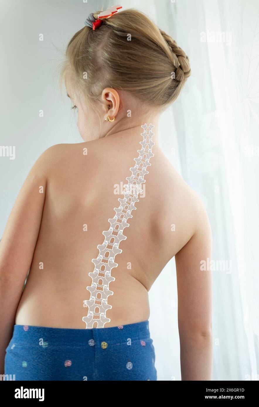back little girl with scoliosis, child 5 years old crookedly standing, spine deformity curved, orthopedic condition, need for medical attention Stock Photo