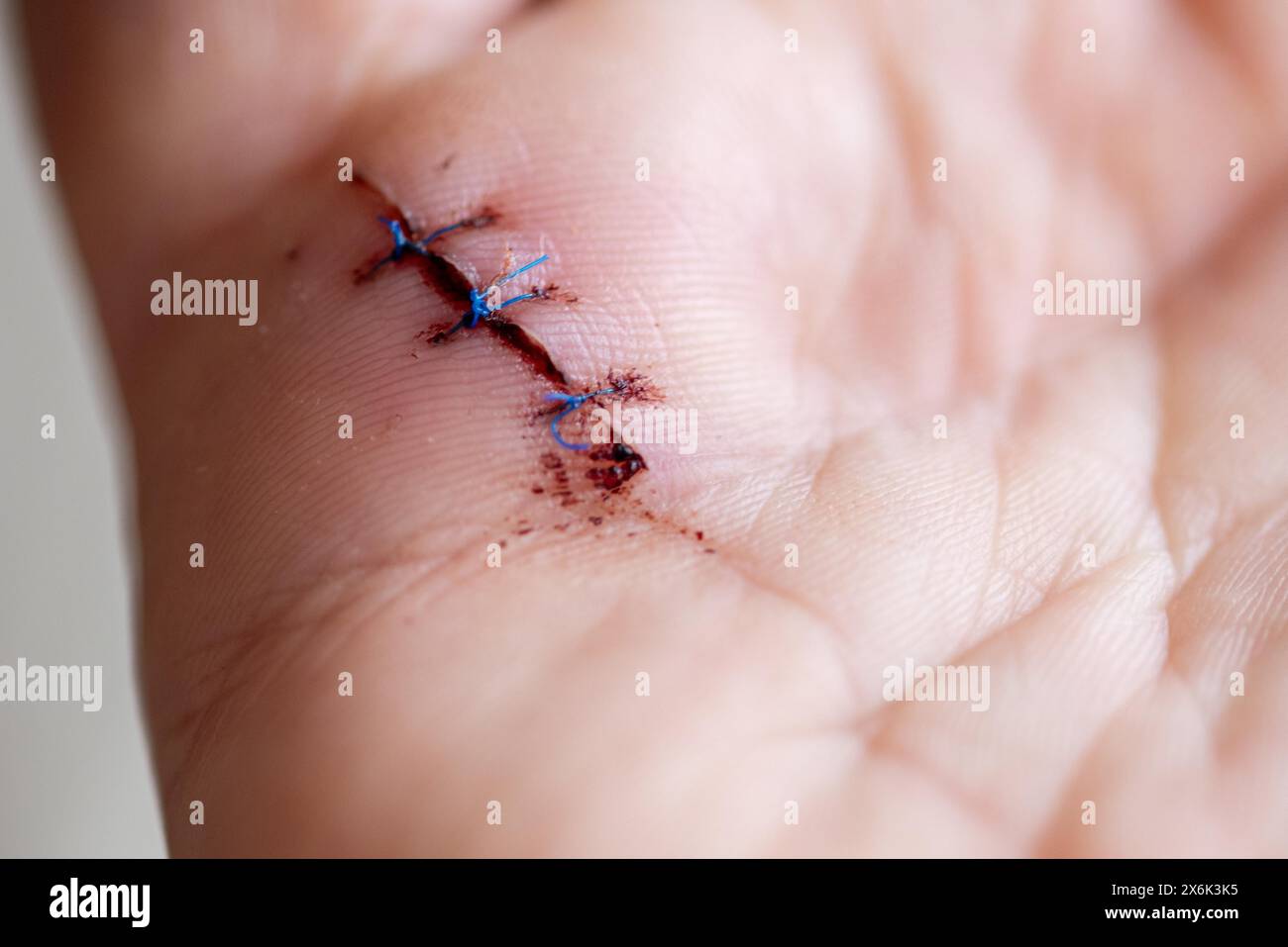 Operated snap finger, wound closed with three stitches, snap finger is the result of tendinitis of the hand, thickening of the tendon disrupts the Stock Photo