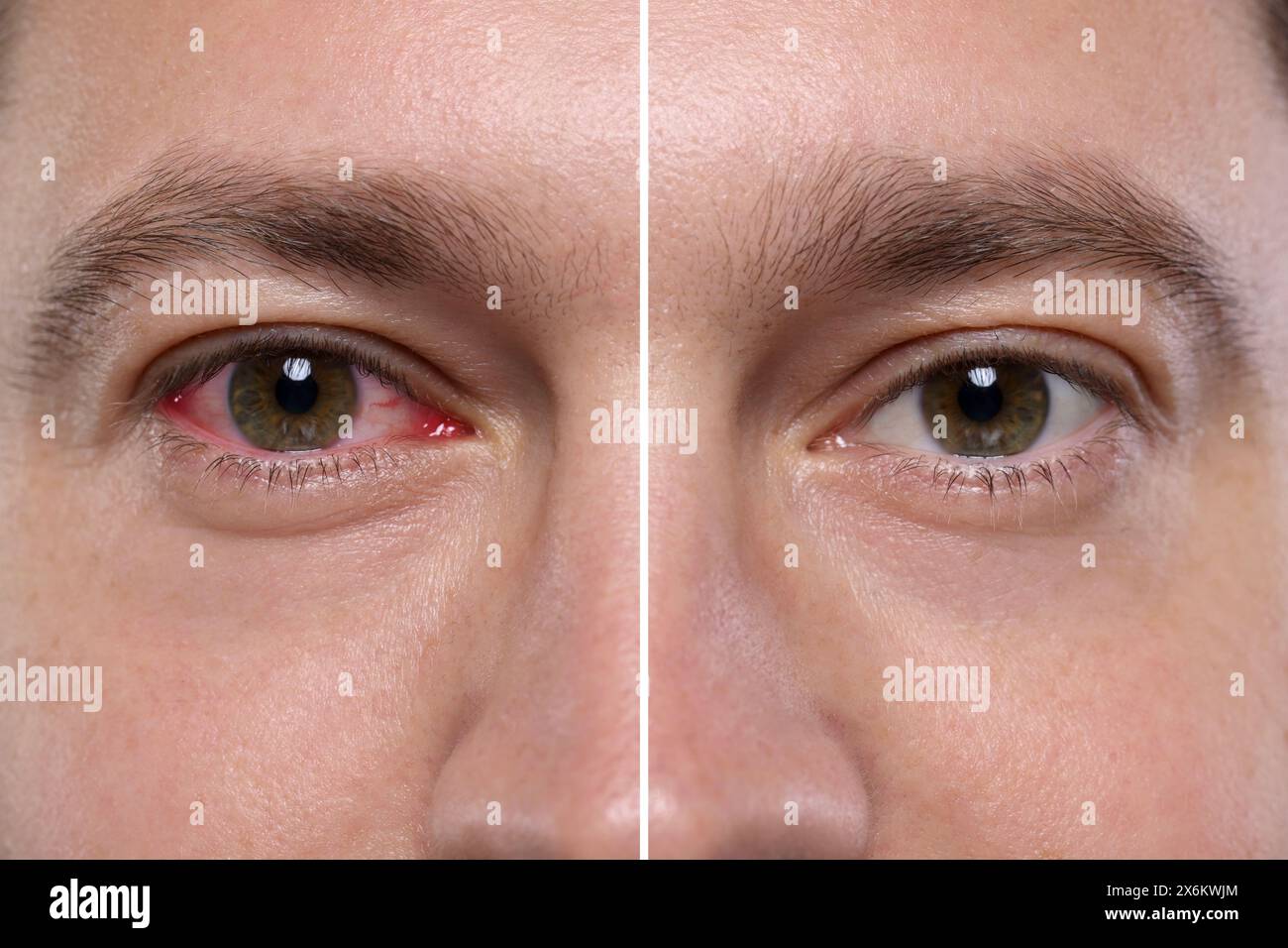Before and after conjunctivitis treatment. Photos of man with red and ...