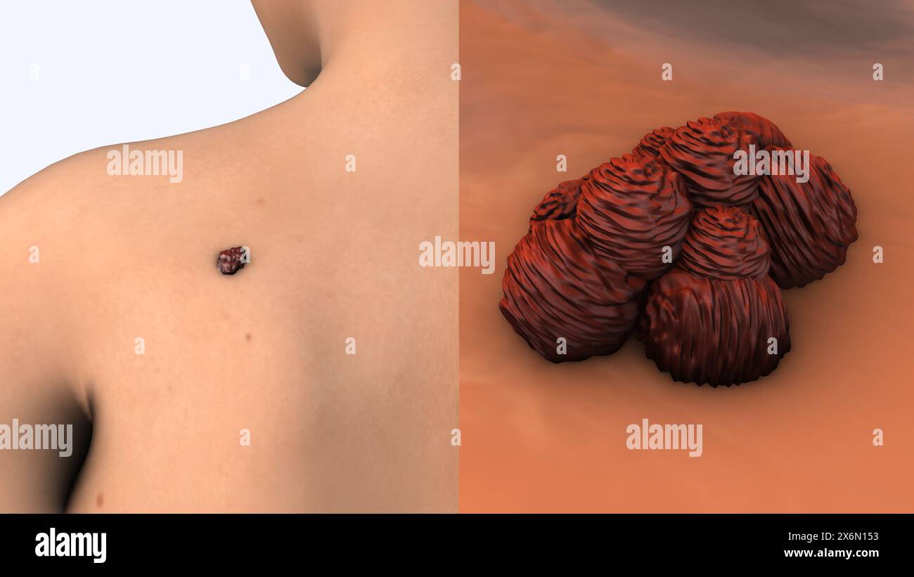 Metastatic melanoma cells medical animation Stock Photo