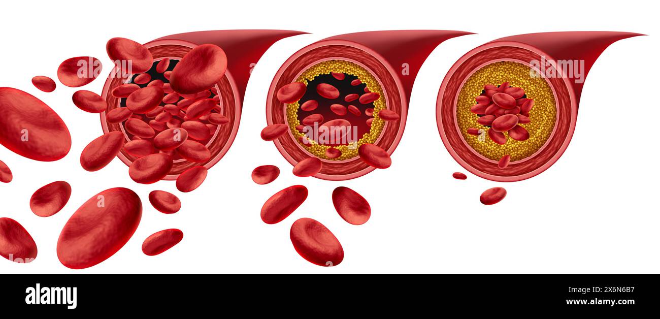 Atherosclerosis Plaque Formation and Clogged arteries disease medical concept with blood cells that is blocked by buildup of cholesterol as a symbol o Stock Photo