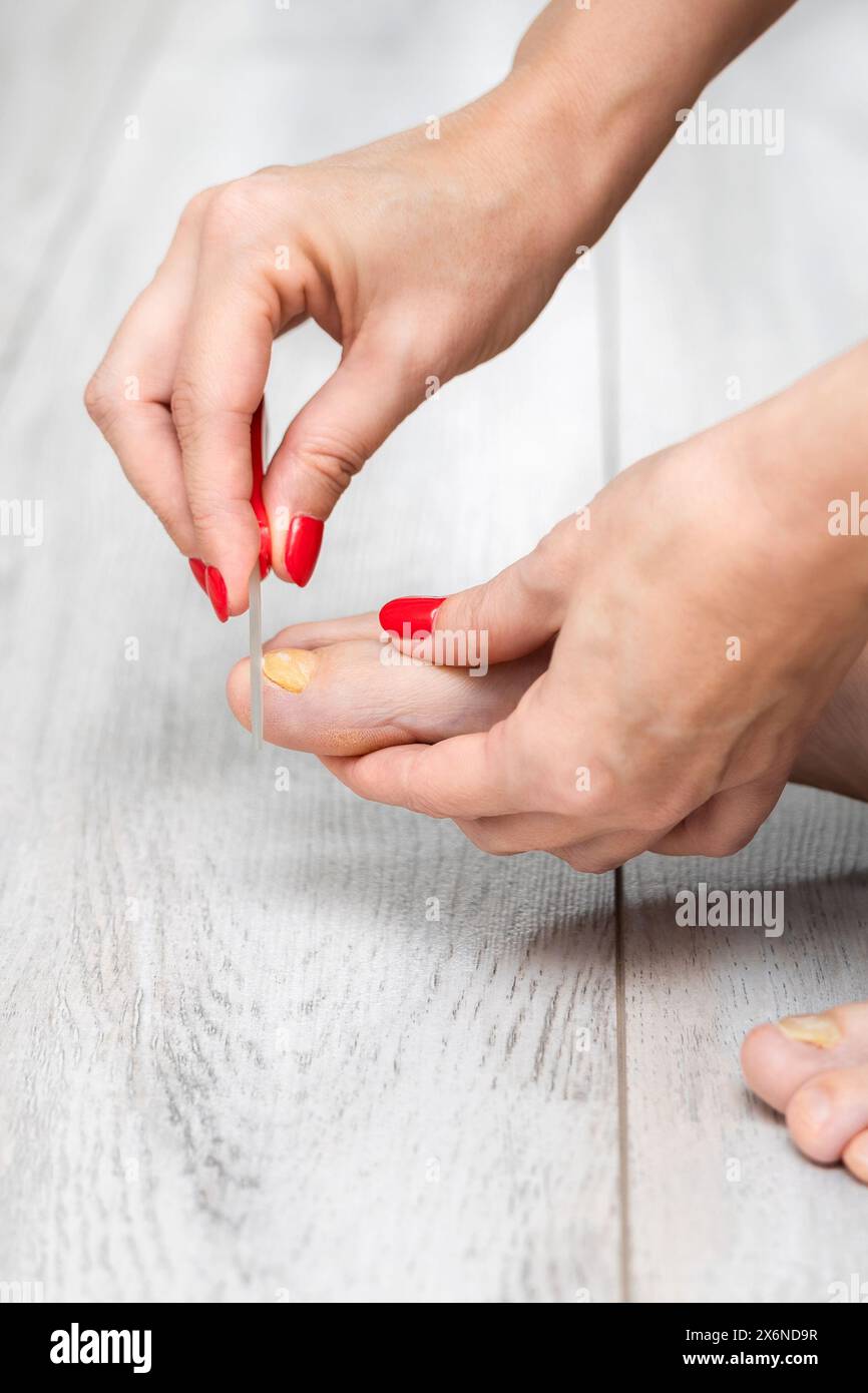 woman sharpens her toenail with a nail file. home pedicure. nail fungus