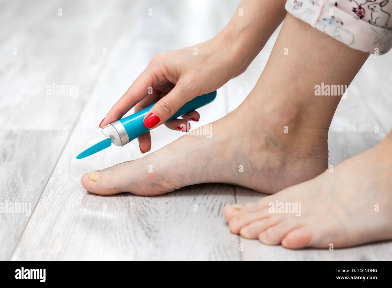 woman sanding her toenails with a sander. nail fungus. toenail disease. woman taking care of toenails. yellow toenail. electric nail grinder. caring f Stock Photo