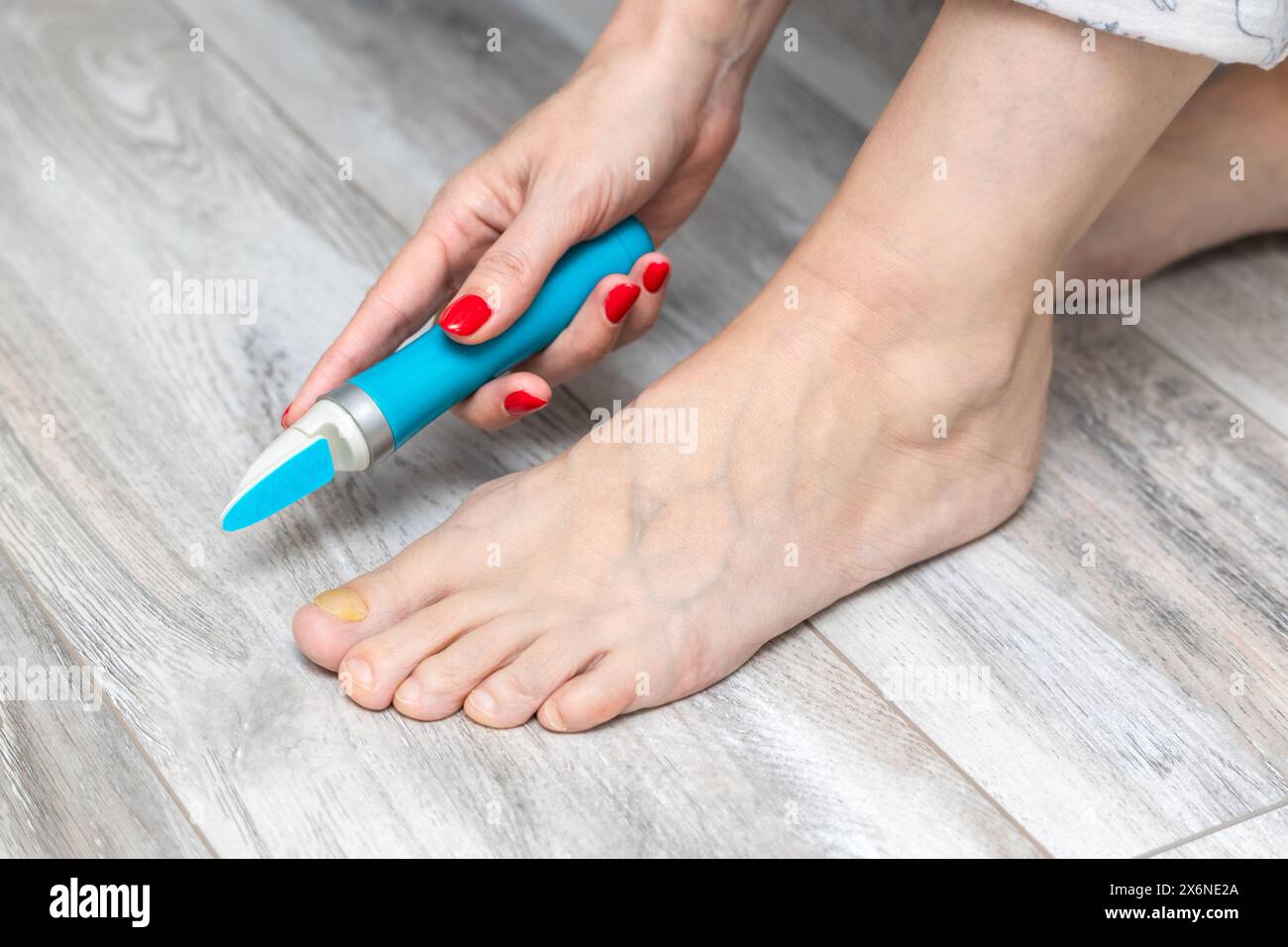 woman sanding her toenails with a sander. nail fungus. toenail disease