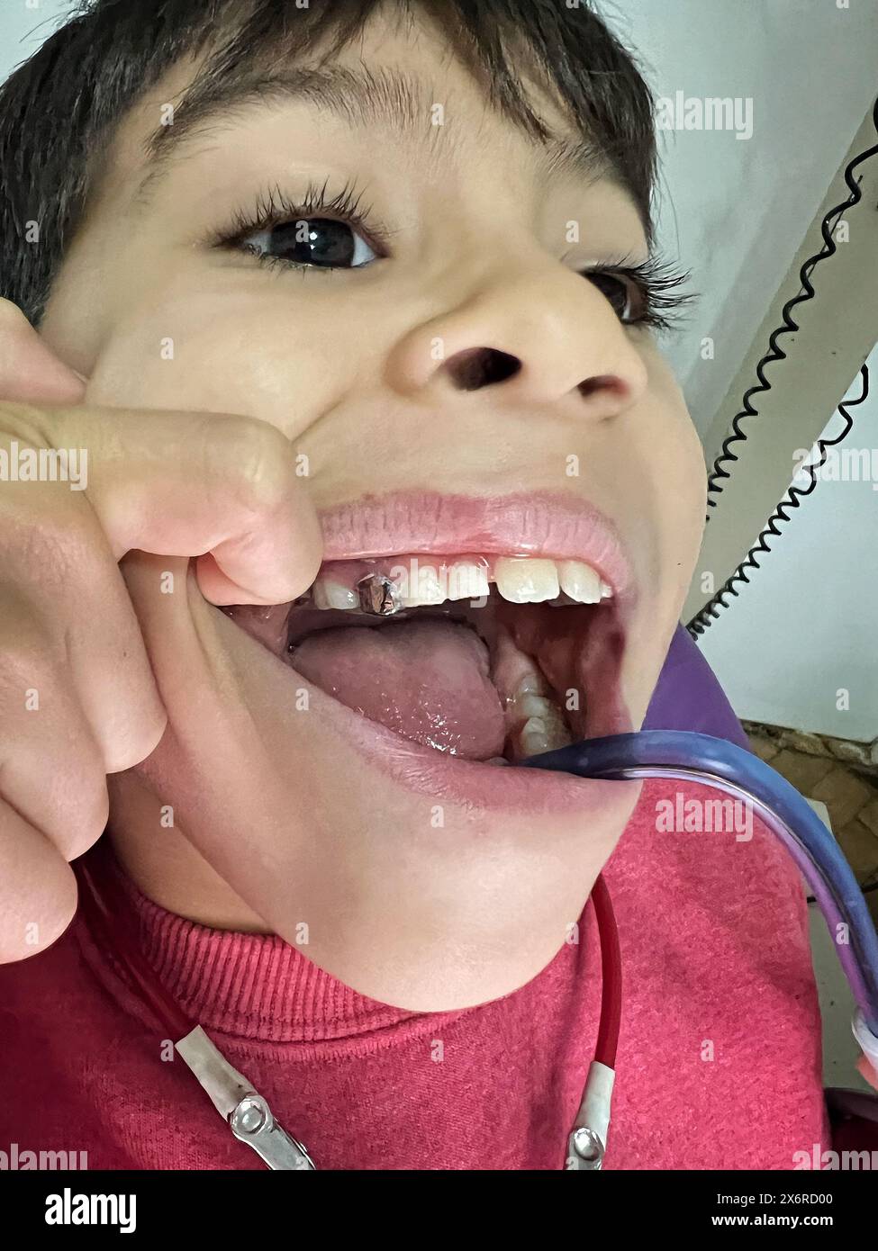 latino child at a dentist's office where a metal crown was placed after a pulpotomy. Pediatric dentist, caries at an early age. Stock Photo