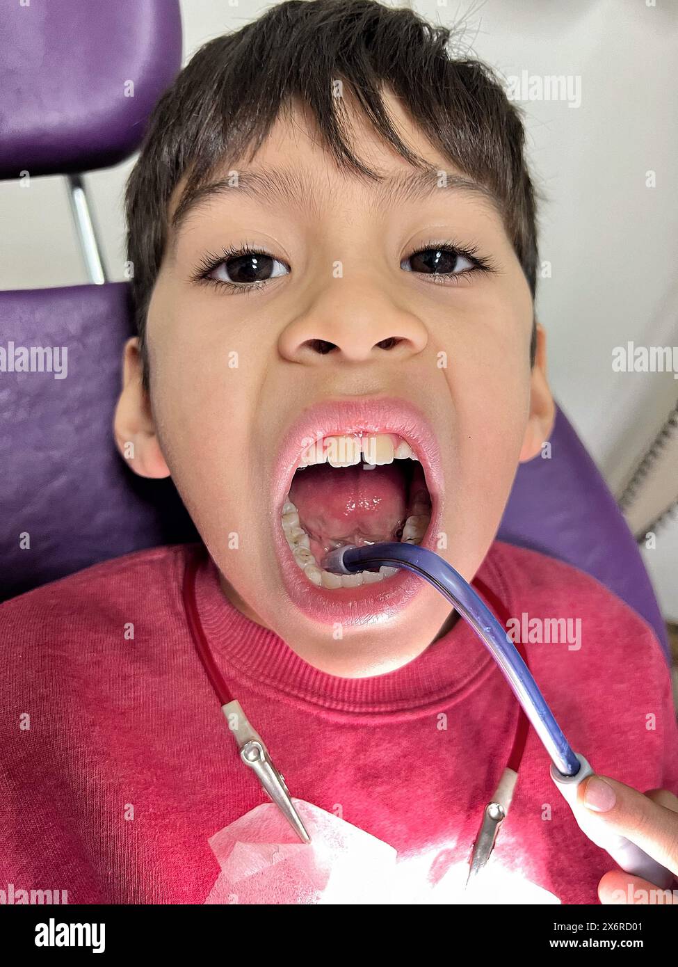 latino child looking at the camera with his mouth open and a hose to swallow saliva at the pediatric dentist for cavity fixes Stock Photo