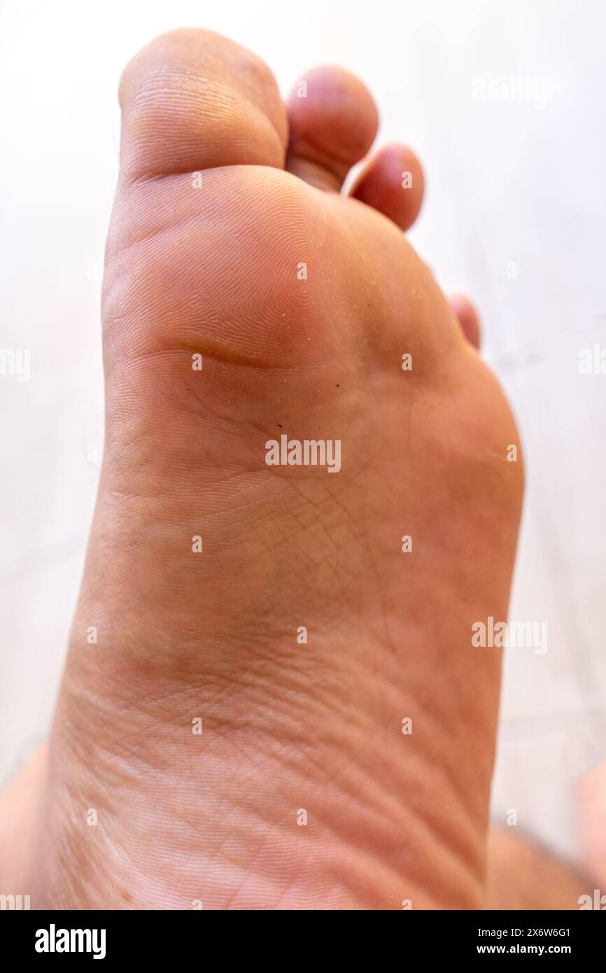 Dry skin, plantar callus and scales on the thumb on white background. Image for medical purposes. Stock Photo
