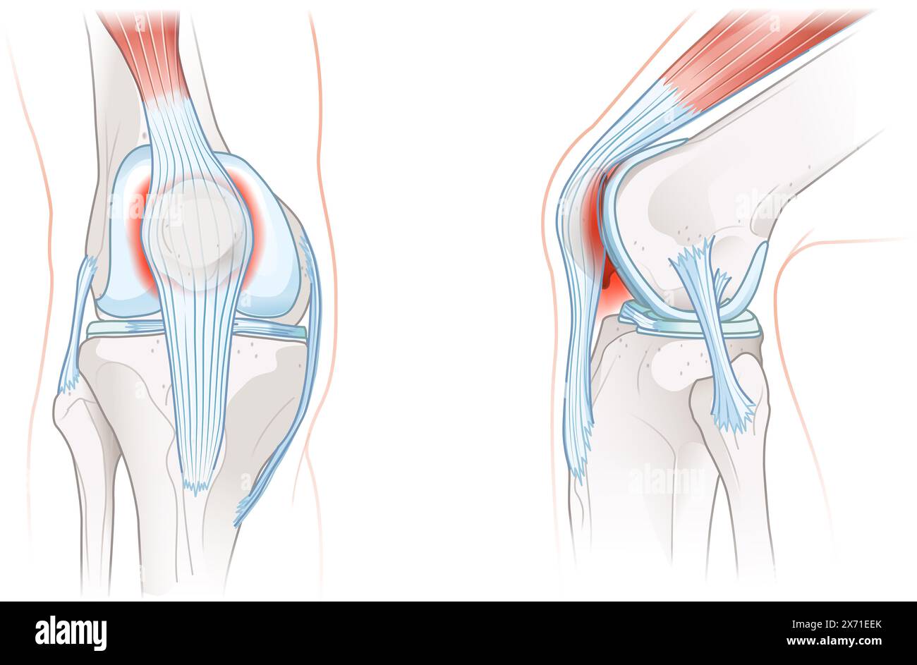 Patellofemoral pain syndrome involves knee discomfort due to malalignment, inflammation, and dysfunction of the patellofemoral joint during movement. Stock Photo