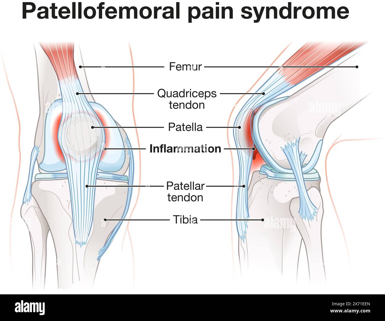 Patellofemoral pain syndrome involves knee discomfort due to malalignment, inflammation, and dysfunction of the patellofemoral joint during movement. Stock Photo