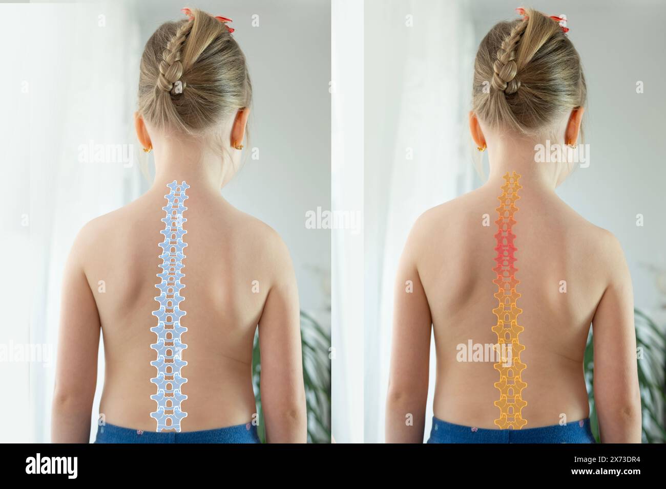 child, young girl showcasing Normal healthy spine and curved spine with scoliosis, need medical attention, spinal health, abnormal spine Stock Photo