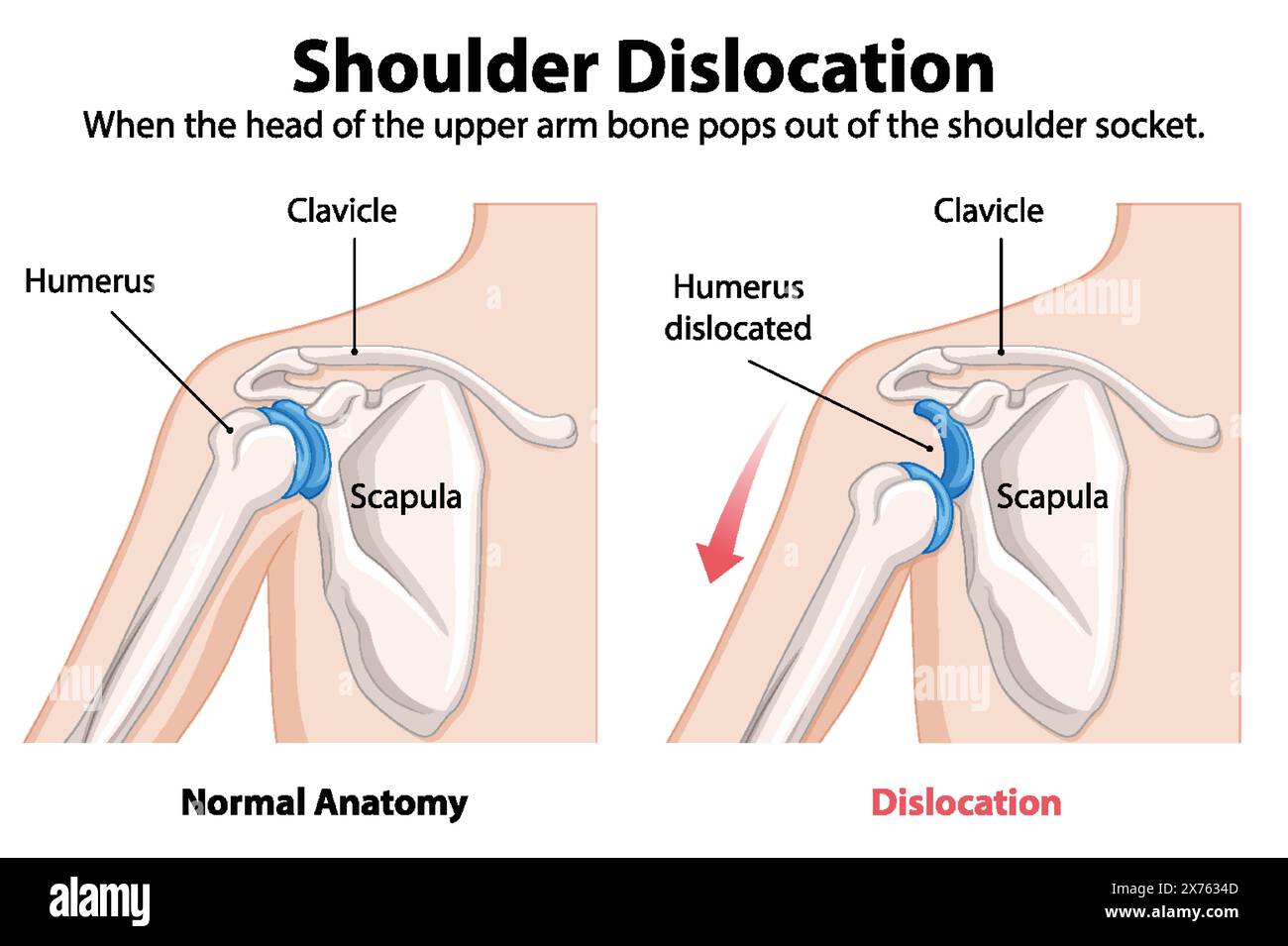 Comparison of normal and dislocated shoulder anatomy Stock Vector Image
