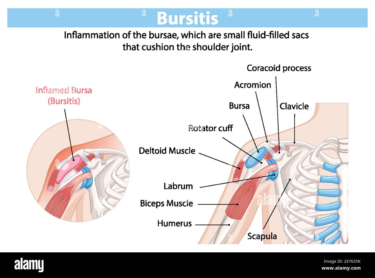 Detailed anatomy of shoulder bursitis inflammation Stock Vector