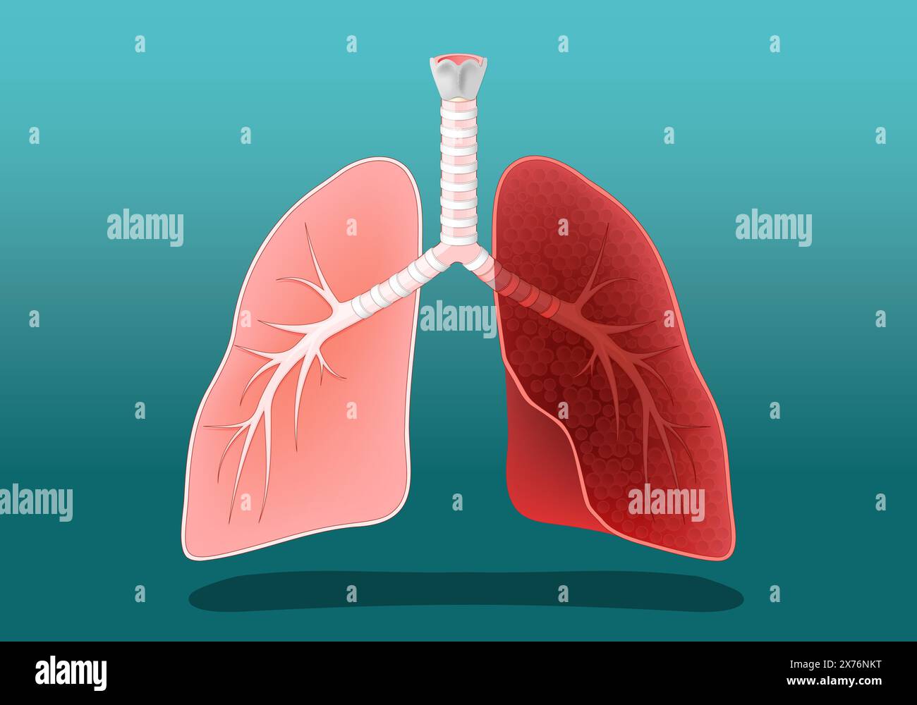 Human lungs. Healthy and diseased, inflamed or like lungs of a smoker, or a person with cancer. Vector poster. Isometric Flat illustration. Stock Vector