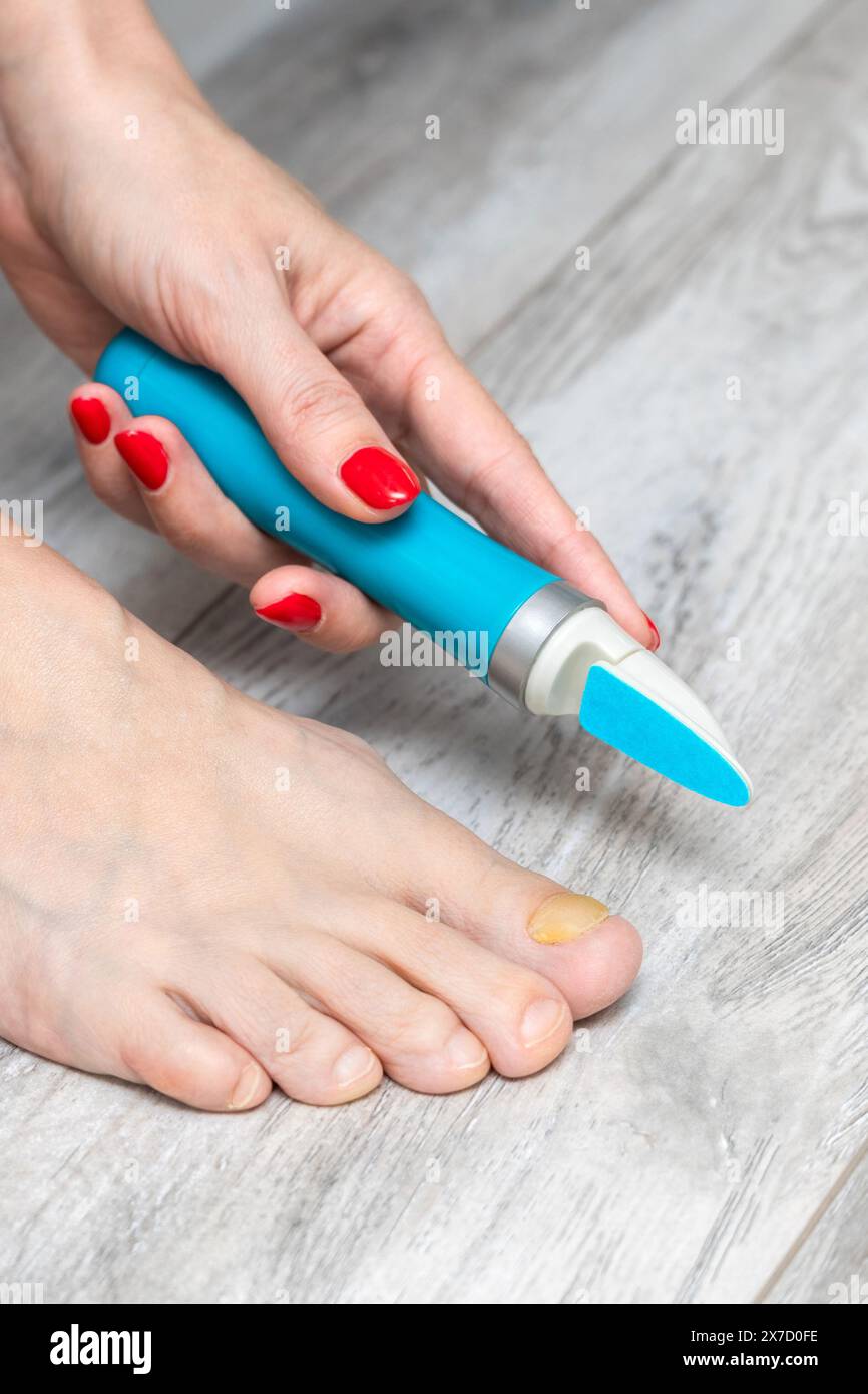 woman sanding her toenails with a sander. nail fungus. toenail disease