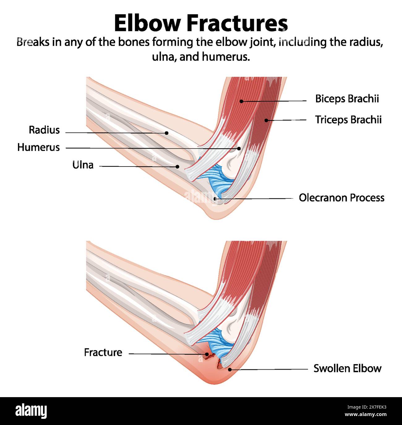 Diagram showing types of elbow fractures Stock Vector
