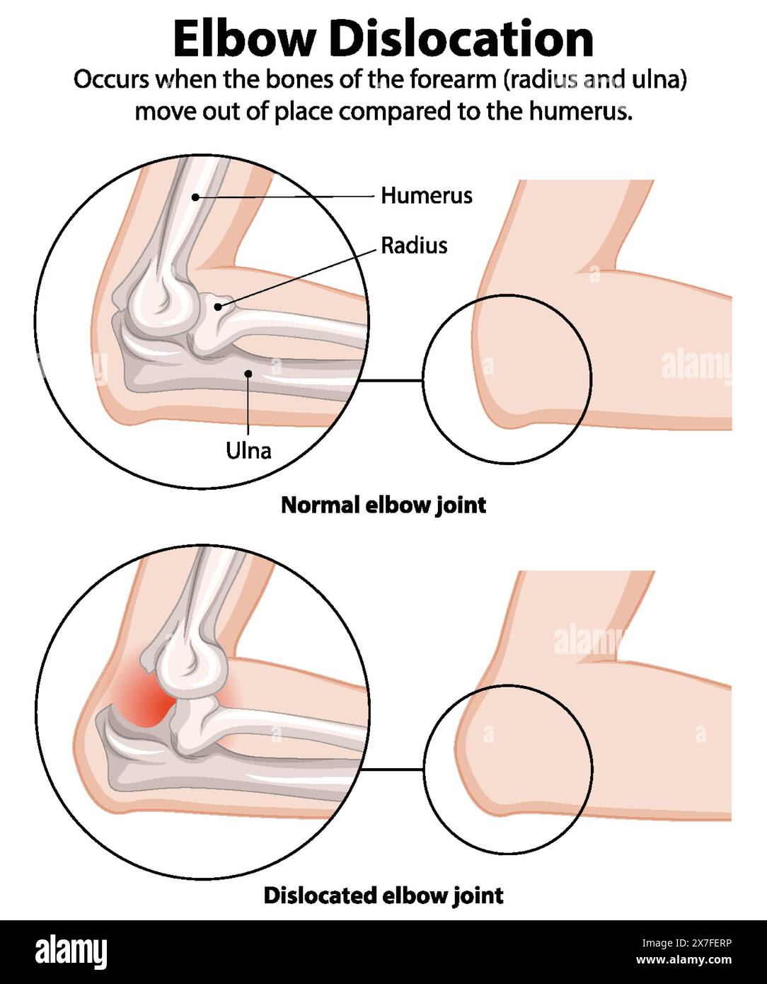 Comparison of normal and dislocated elbow joints Stock Vector Image ...