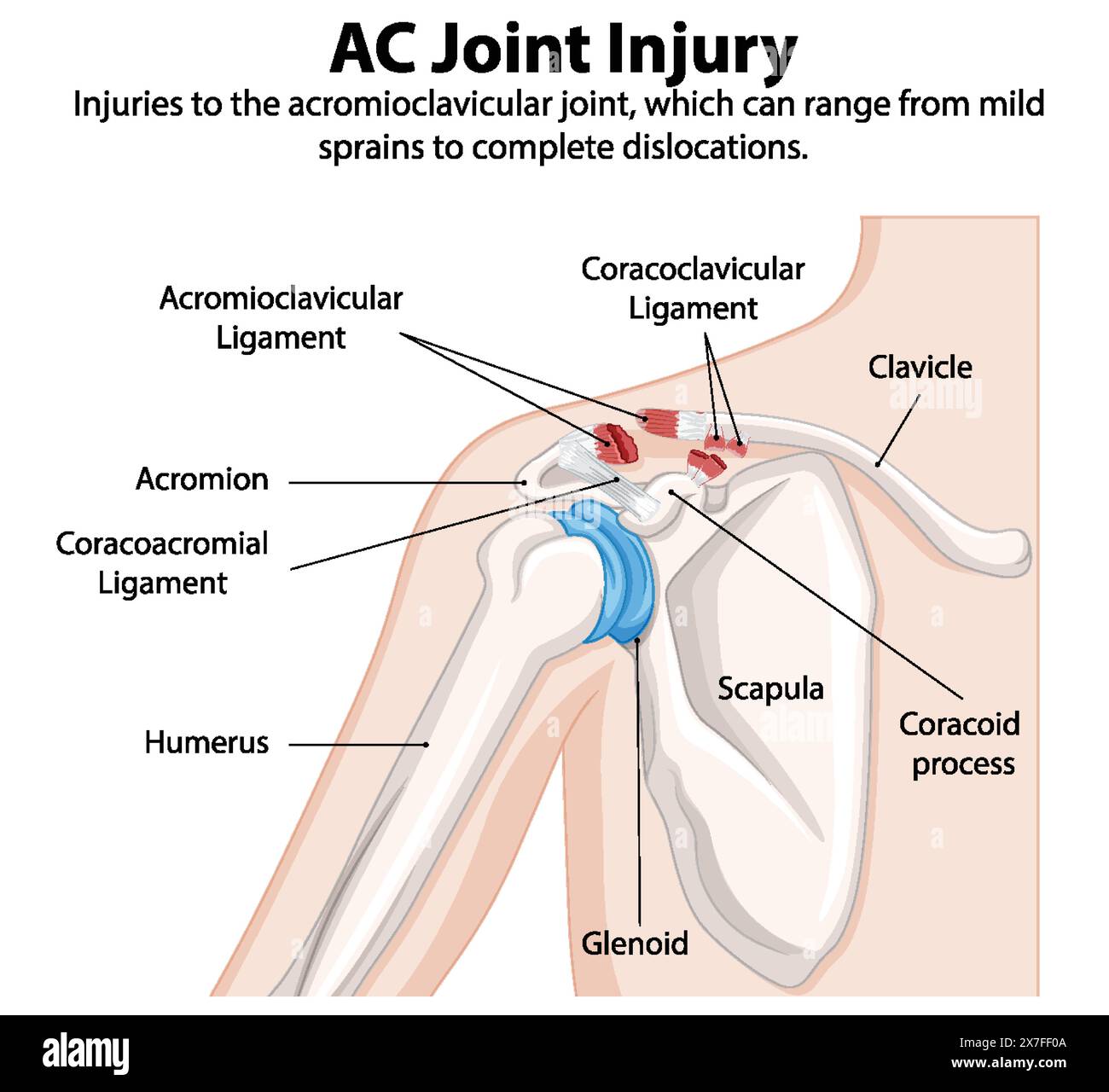 Detailed illustration of shoulder joint anatomy and injuries Stock Vector