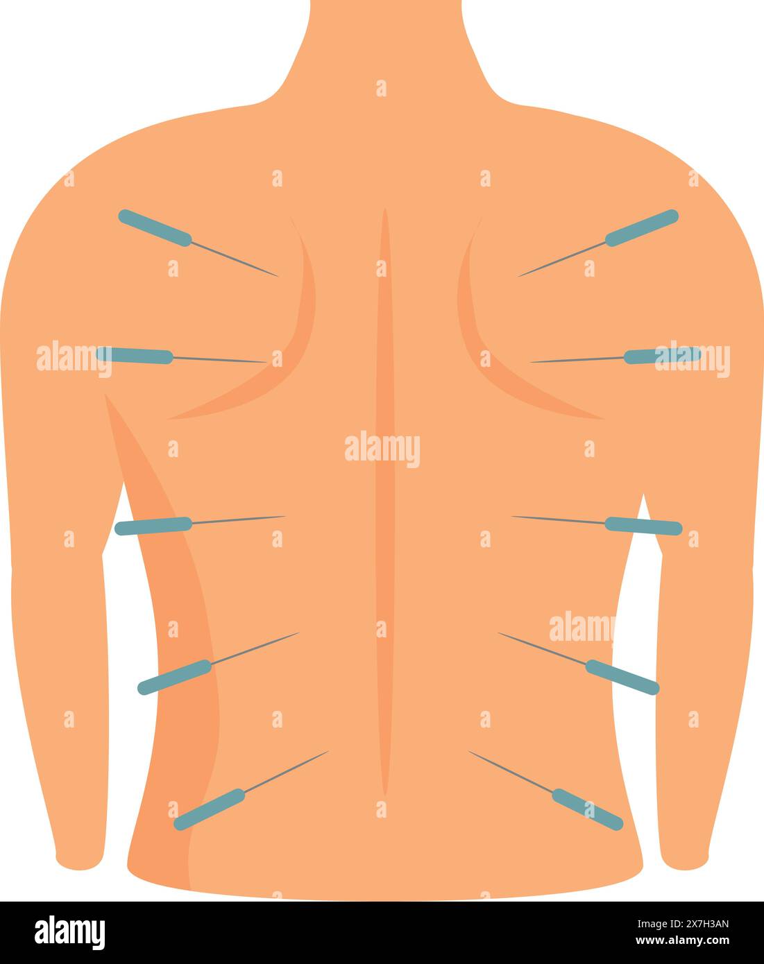 Holistic acupuncture therapy illustration for alternative back pain ...